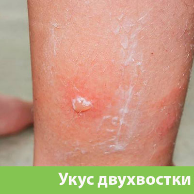 Укус двухвостки в Солнечногорске