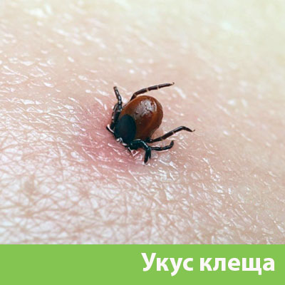 Укус клеща в Солнечногорске