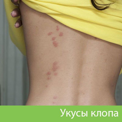 Профессиональное уничтожение клопов в Солнечногорске